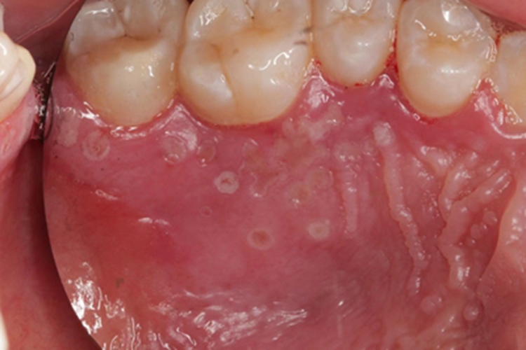 原发性口腔单纯性疱疹口腔水疱图 原发性口腔单纯性疱疹口腔水疱图