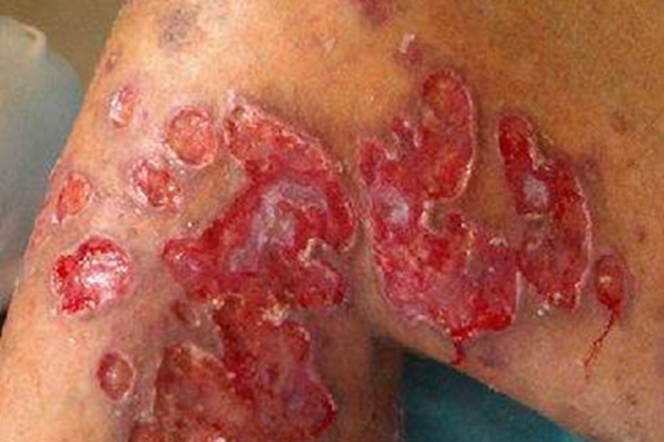 瘰疬性皮肤结核腿症状图 瘰疬性皮肤结核腿症状图