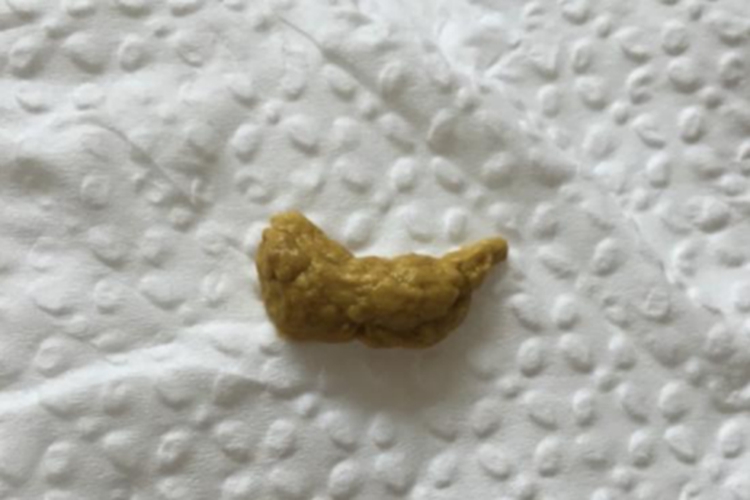 六个月婴儿灰黄色大便图