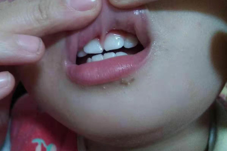 唇系带附着过低图