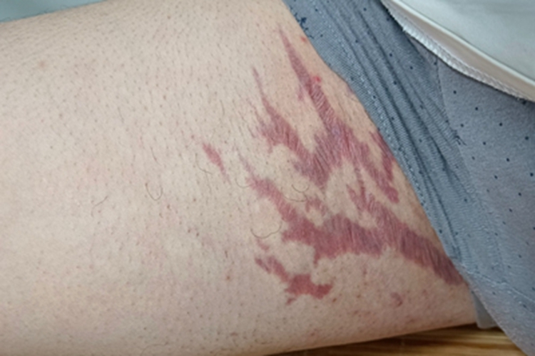 大腿萎缩纹症状图