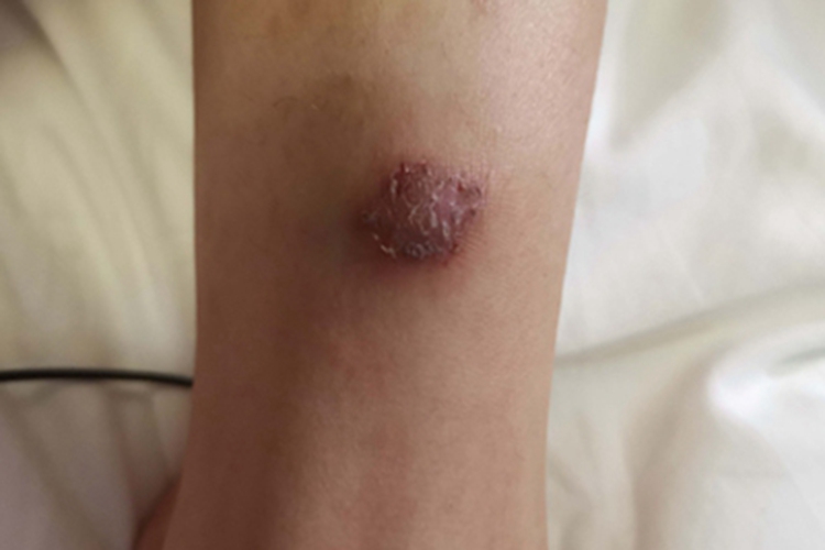 昆虫性皮炎小腿脱皮图 昆虫性皮炎小腿脱皮图
