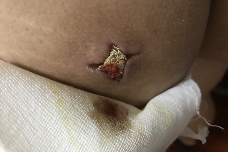 疖和痈脓肿引流切口图