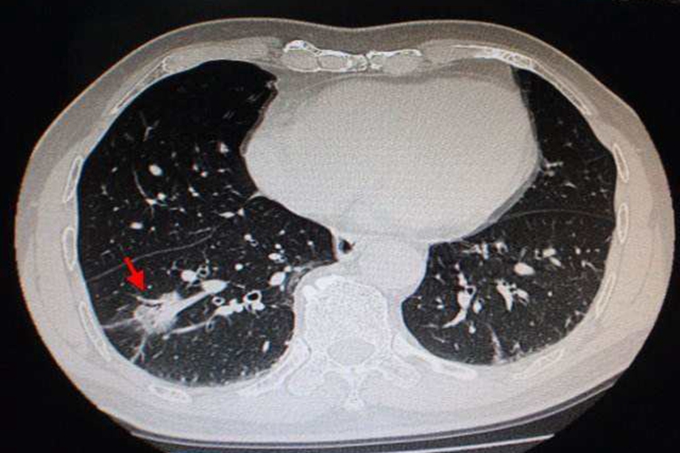 肺部恶性肿瘤图