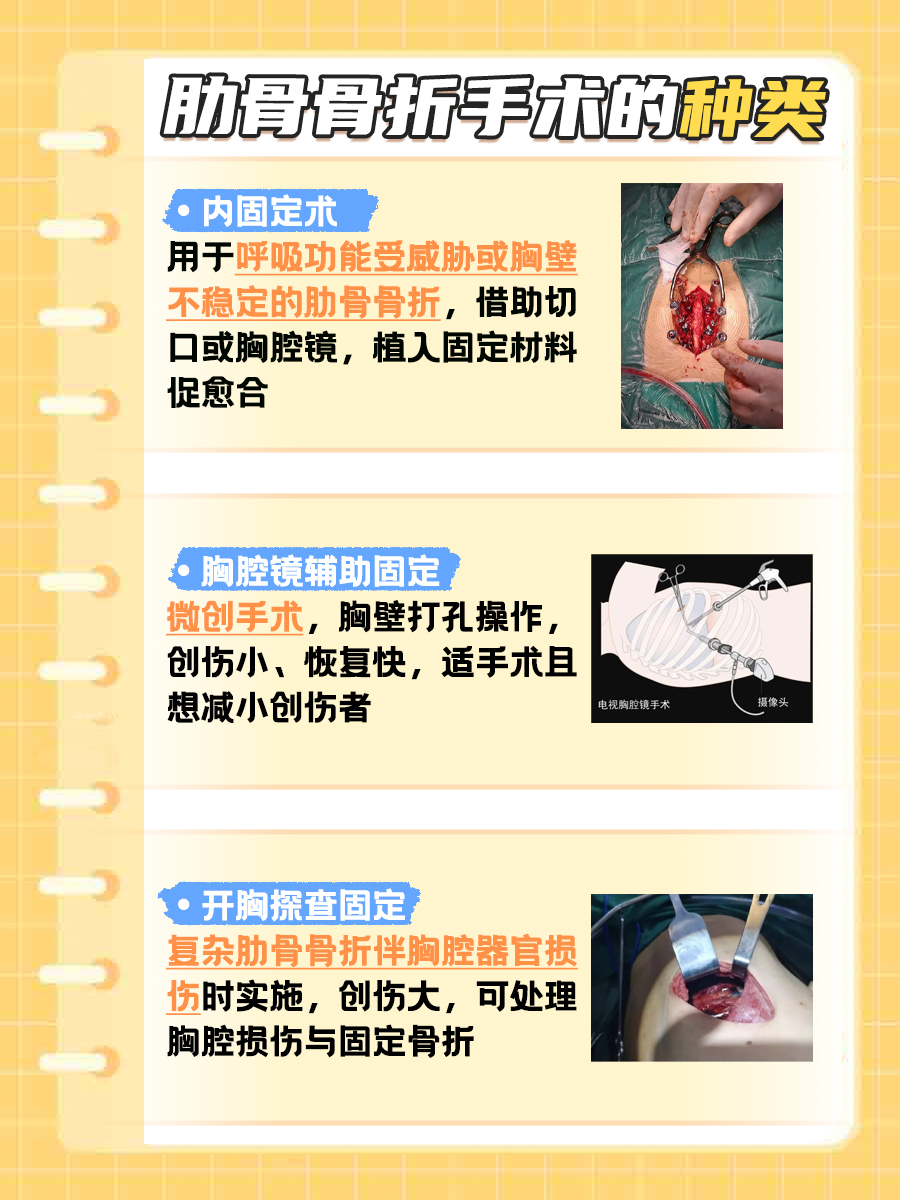 肋骨骨折手术的种类有哪些？一文了解