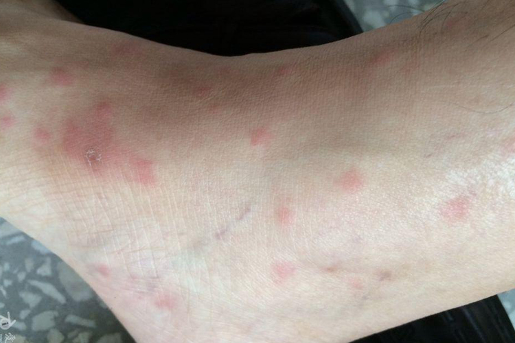 急性接触性皮炎图 急性接触性皮炎图