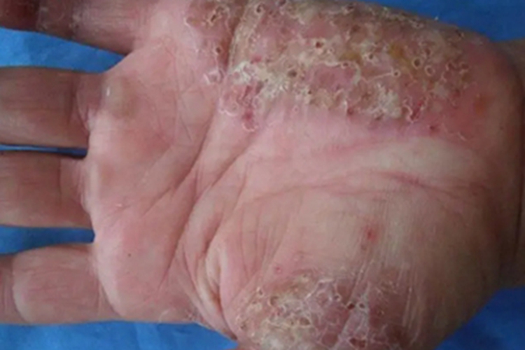 角层下脓疱病手掌小孔图