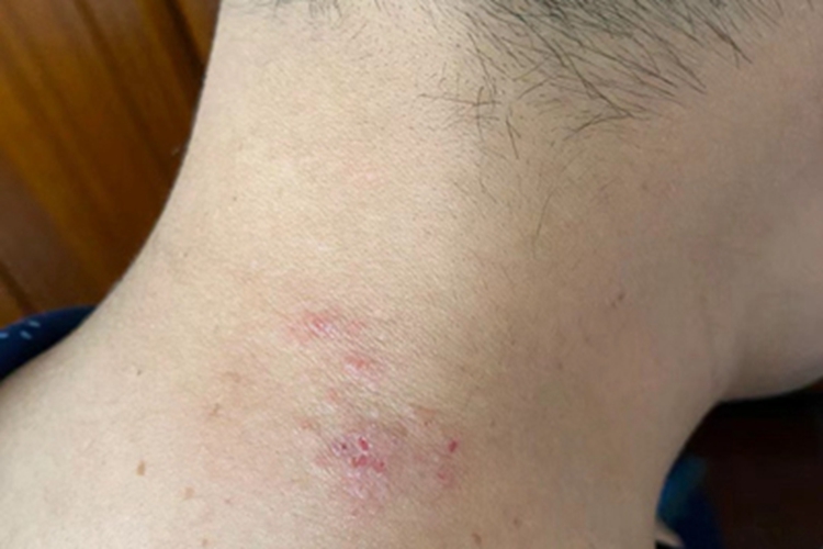 急性湿疹后颈有一小片疙瘩图