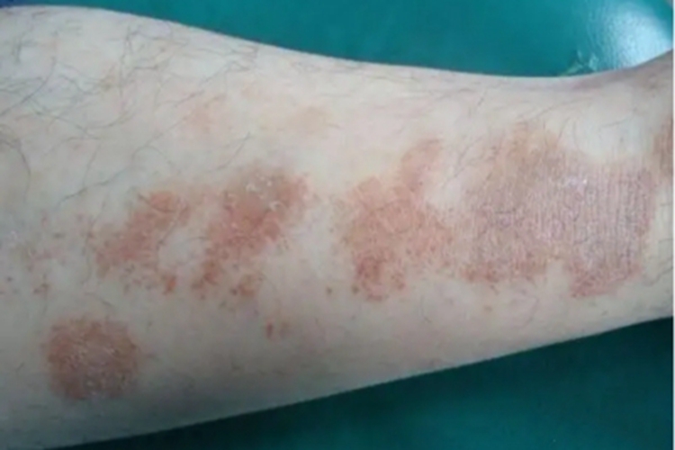 色素性紫癜性皮疹小腿症状图