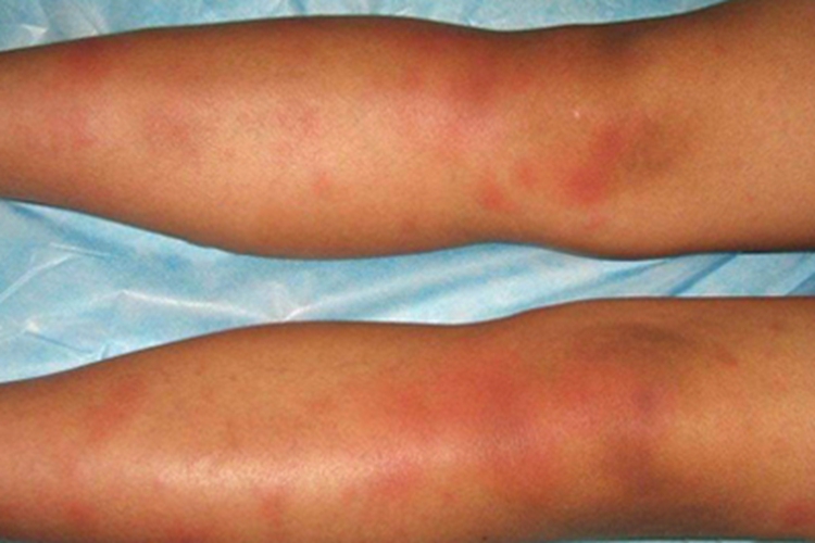 结节性红斑早期症状图