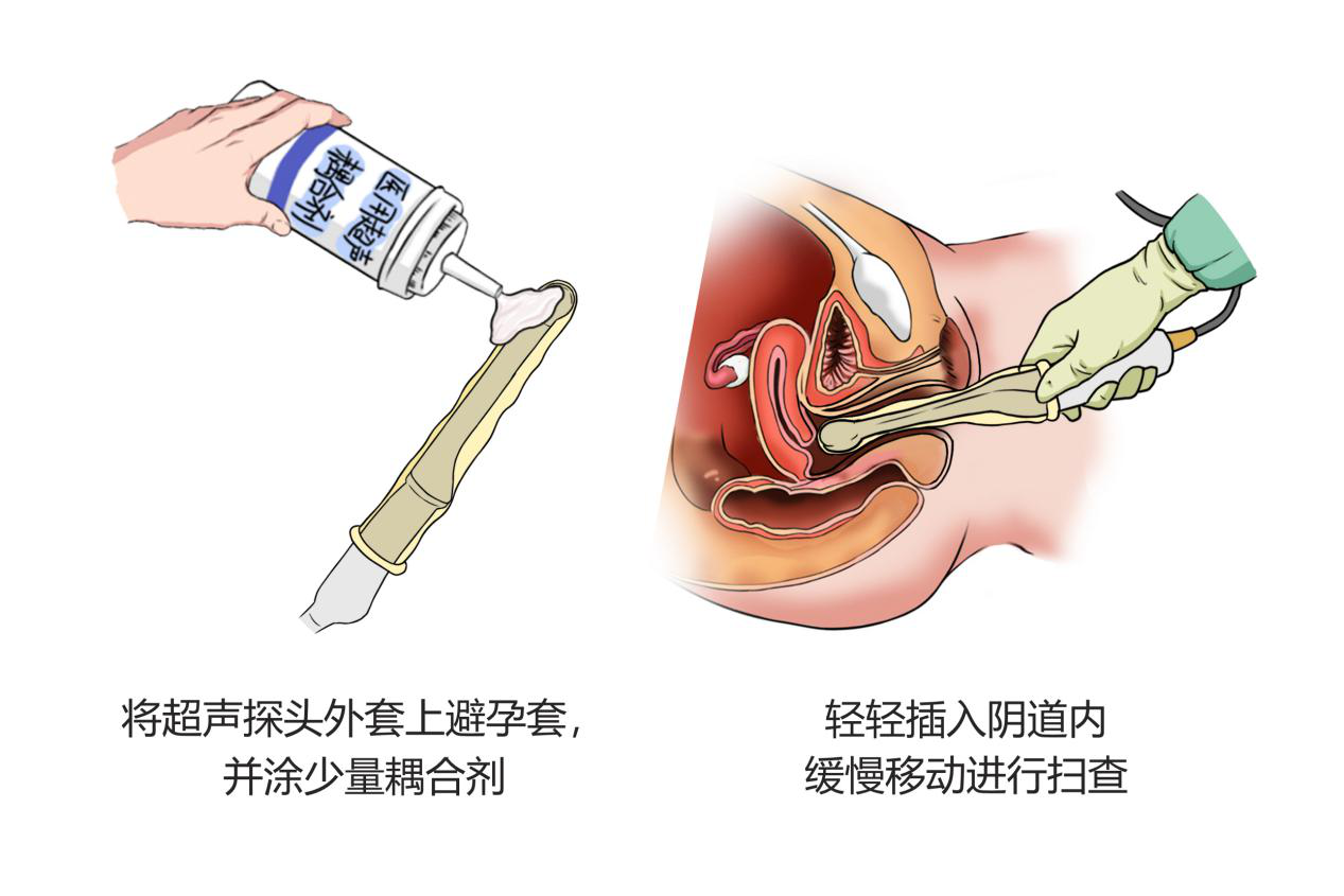 妇科超声步骤大揭秘