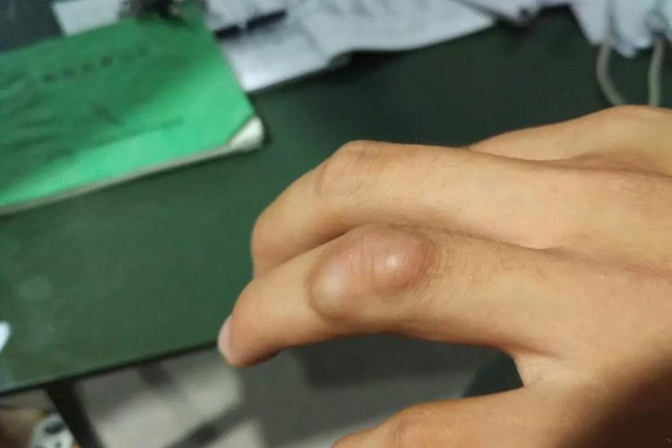 孩子手指腱鞘囊肿图