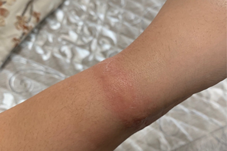 皮革皮炎手腕红肿图