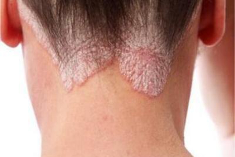 斑状淀粉样变后颈症状图 斑状淀粉样变后颈症状图