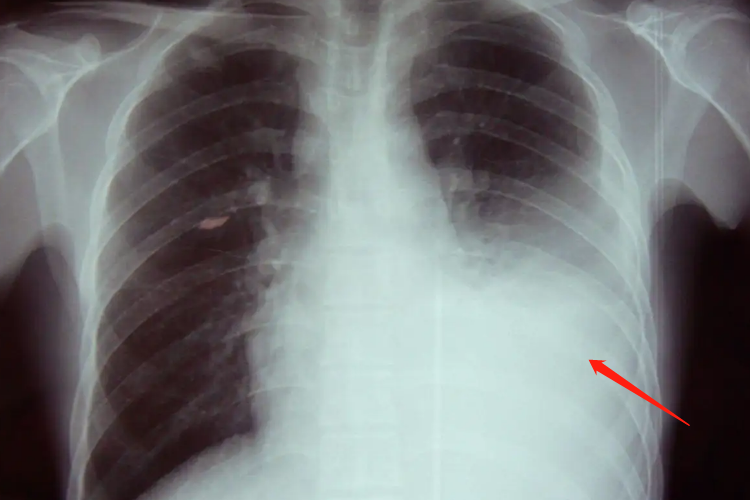 肺部有炎症的胸透图