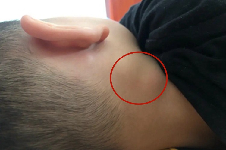 传染性单核细胞增多症图