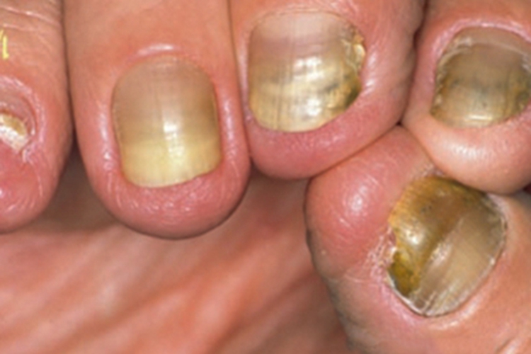 黄甲综合征症状图