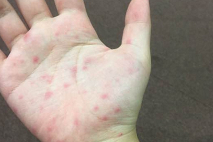 湿疹样紫癜手掌红斑点图