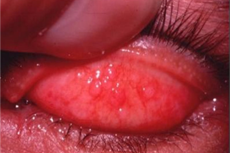 特应性角结膜炎症状图 特应性角结膜炎症状图