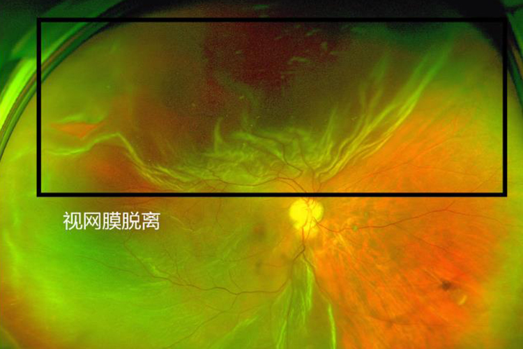 视网膜脱落闪光感图片