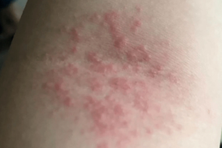 急性湿疹胳膊长一片红疙瘩图