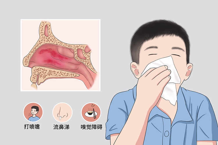 宝宝急性鼻炎图