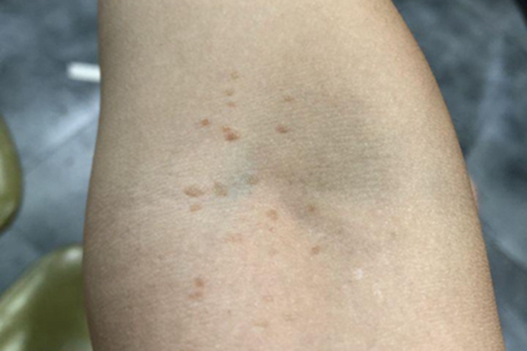 疣肘部症状图 疣肘部症状图