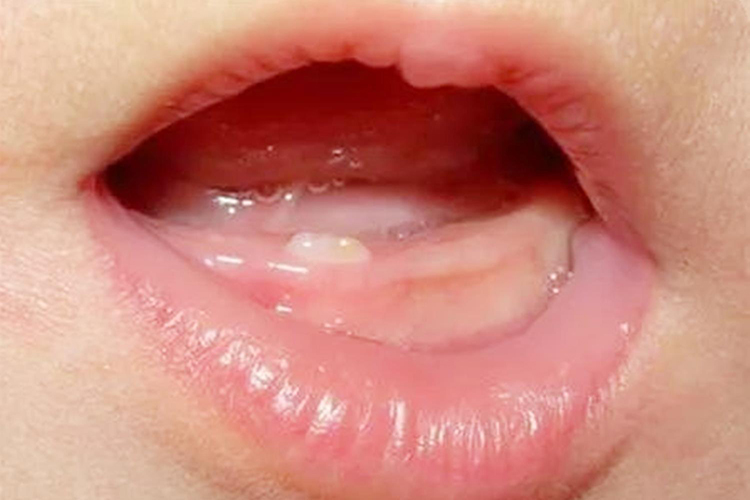 门牙刚长出的样子图