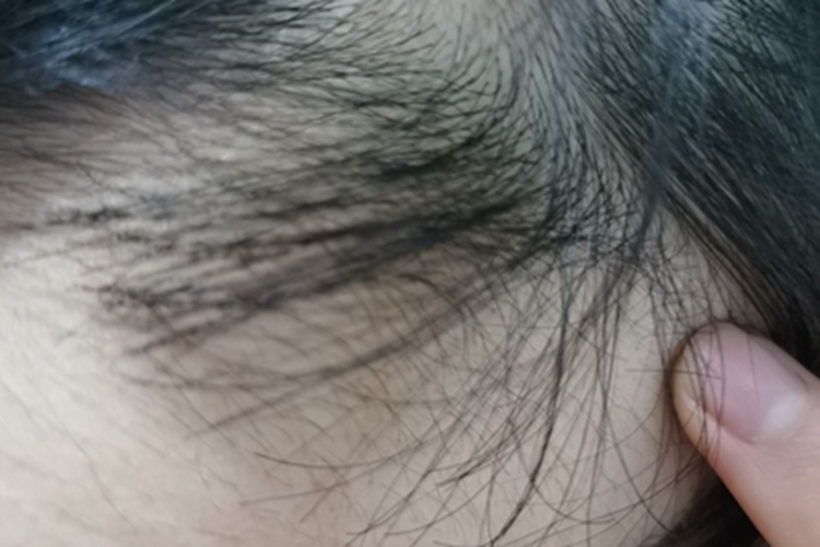 油风脱发头发稀疏图