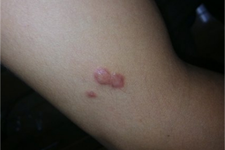 隆突性皮肤纤维肉瘤粉红色结节图