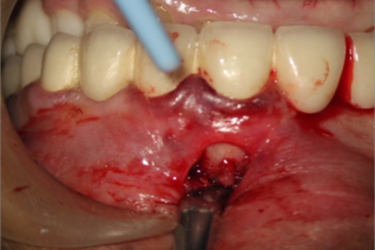 急性化脓性根尖周炎牙龈出血图