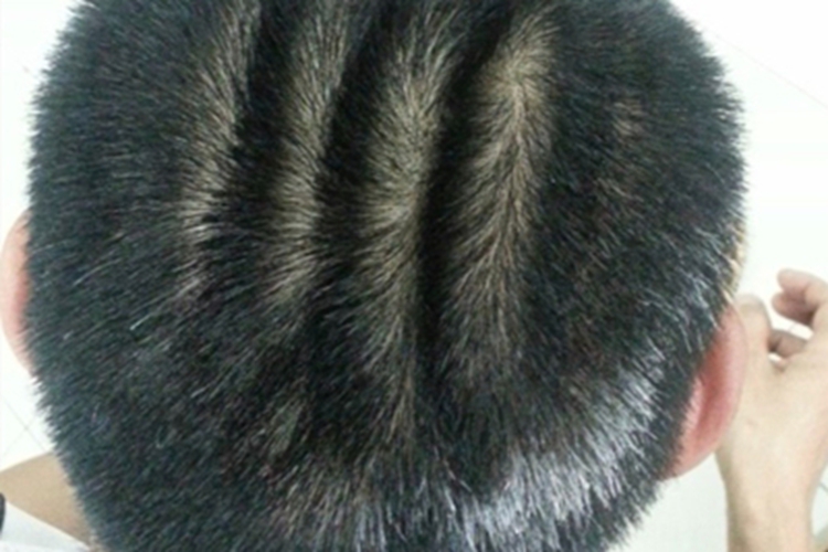 继发性回状颅皮头皮症状图 继发性回状颅皮头皮症状图