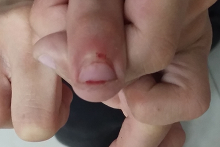 外伤手指甲破皮出血图 外伤手指甲破皮出血图