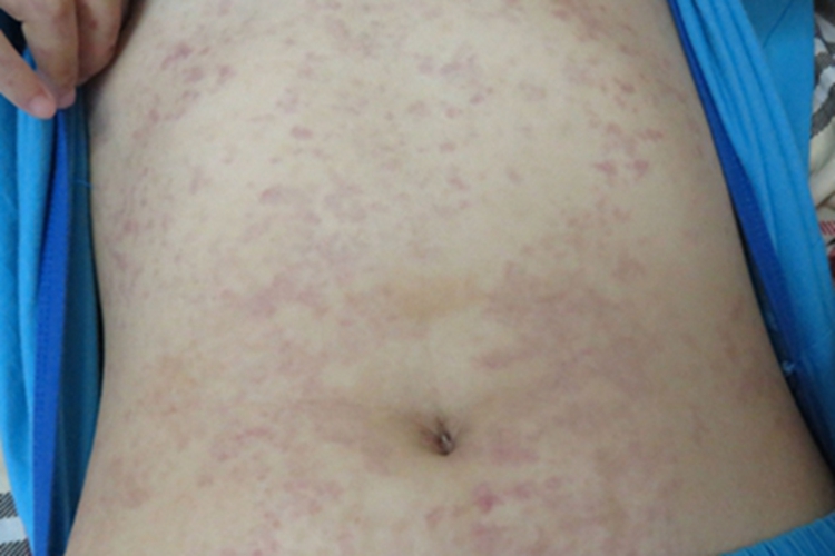 过敏性紫癜腹部有红斑图