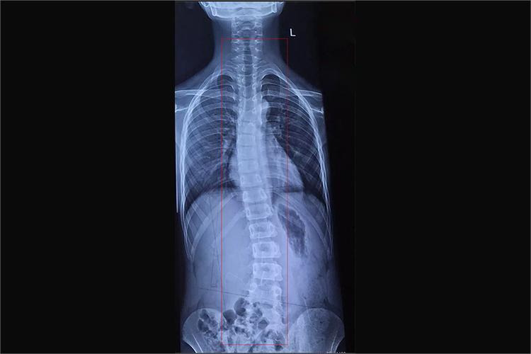 脊柱侧弯15度X线片图