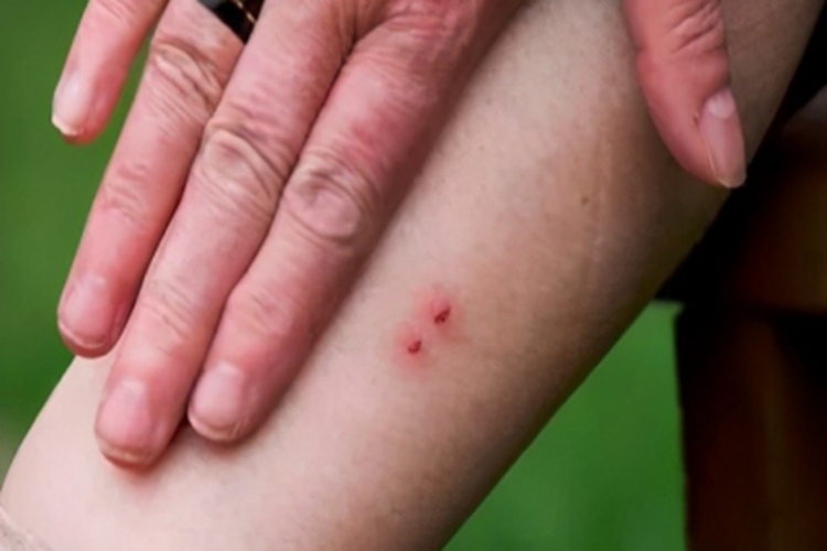 毒蛇咬伤血点图