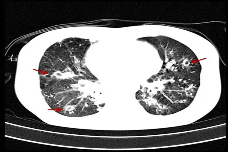 肺结核ct图片早期图片