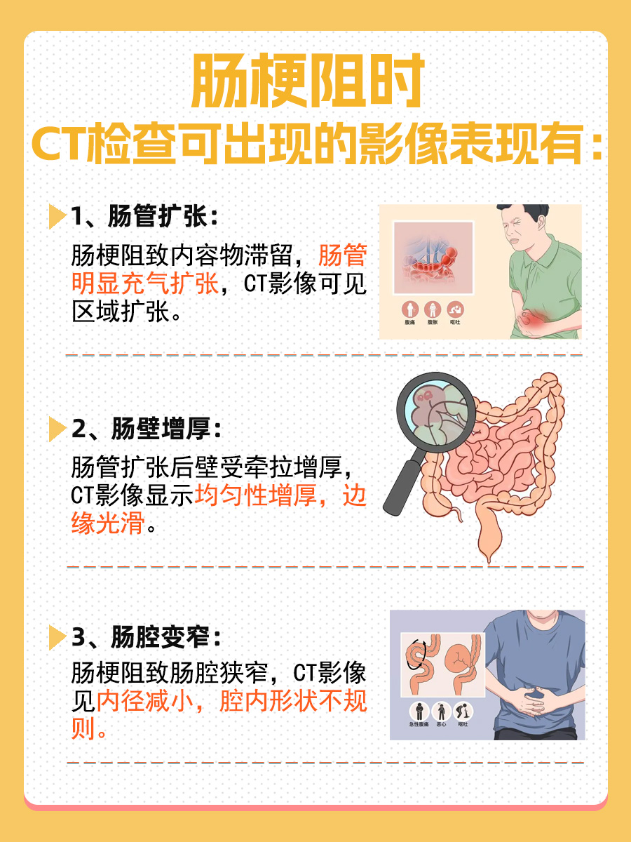 肠梗阻CT检查影像表现?医生告诉你
