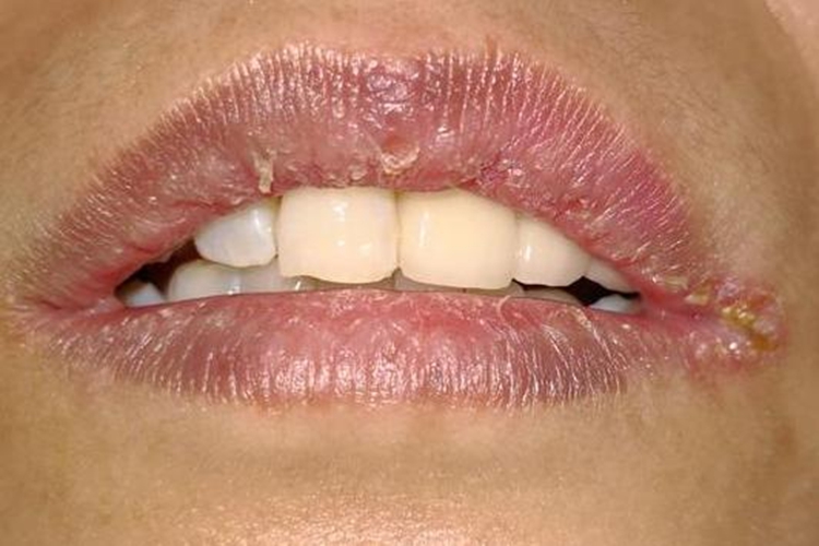 口腔白色念珠菌性唇炎图