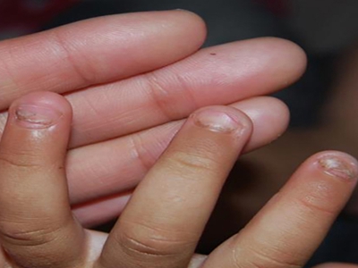 锌缺乏症指甲萎缩图.jpg
