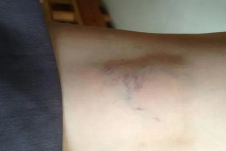 腘窝处静脉曲张早期图 腘窝处静脉曲张早期图