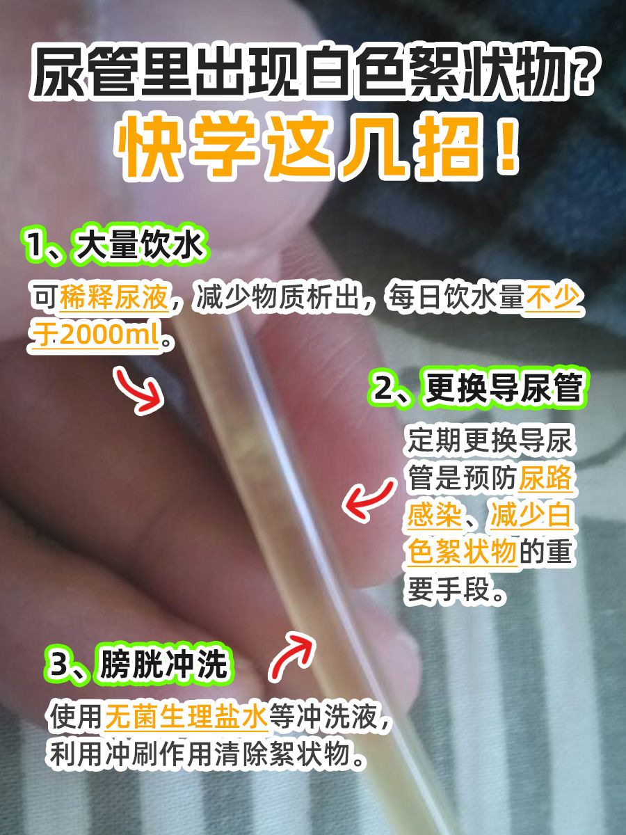 尿管有白色絮状物？别急，处理措施看这里！