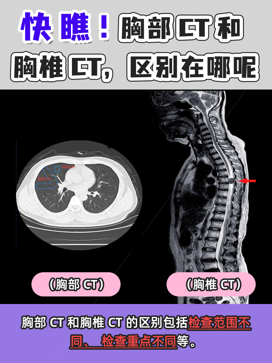 快瞧!胸部CT和胸椎CT,区别在哪呢