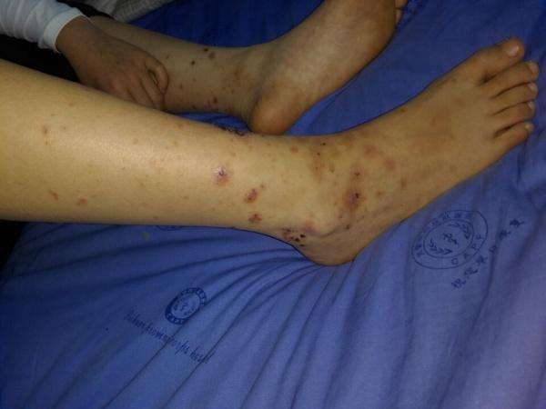 坏血病皮肤瘀斑图