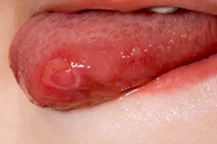 复发性口疮水疱图 复发性口疮水疱图