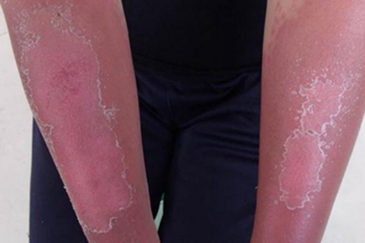 日光性皮炎胳膊脱皮图