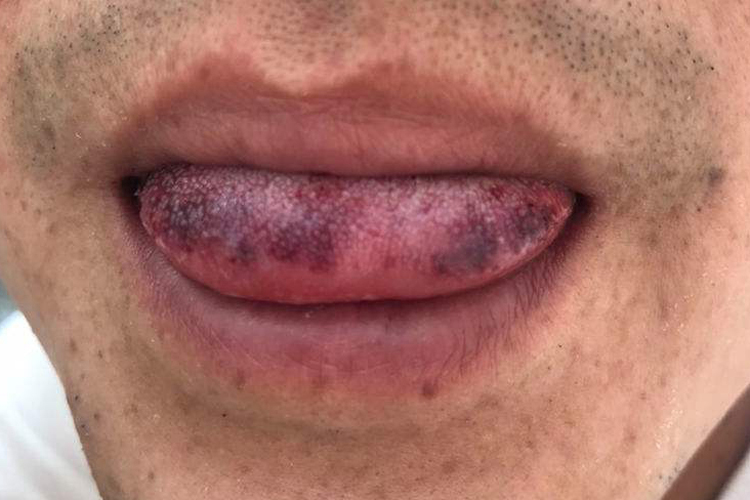 血瘀证舌尖紫黑色瘀点图