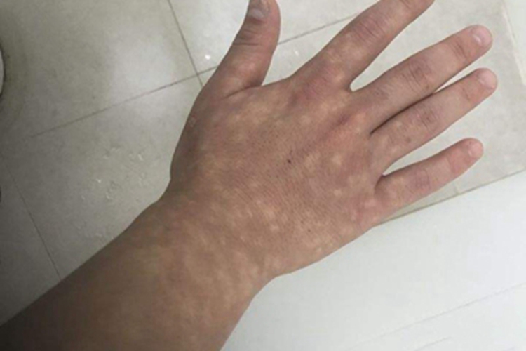 马歇尔-怀特综合征手背长白斑图 马歇尔-怀特综合征手背长白斑图