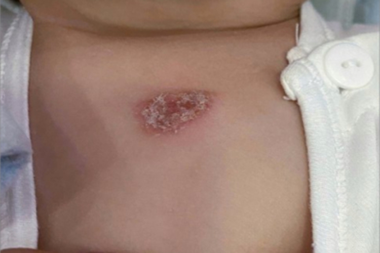 干燥型婴儿湿疹脱屑图