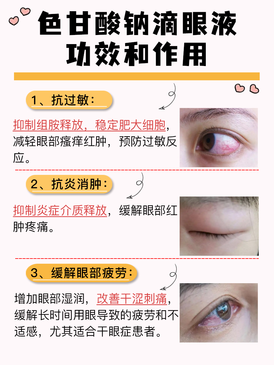 医生用药指南：色甘酸钠滴眼液功效和作用